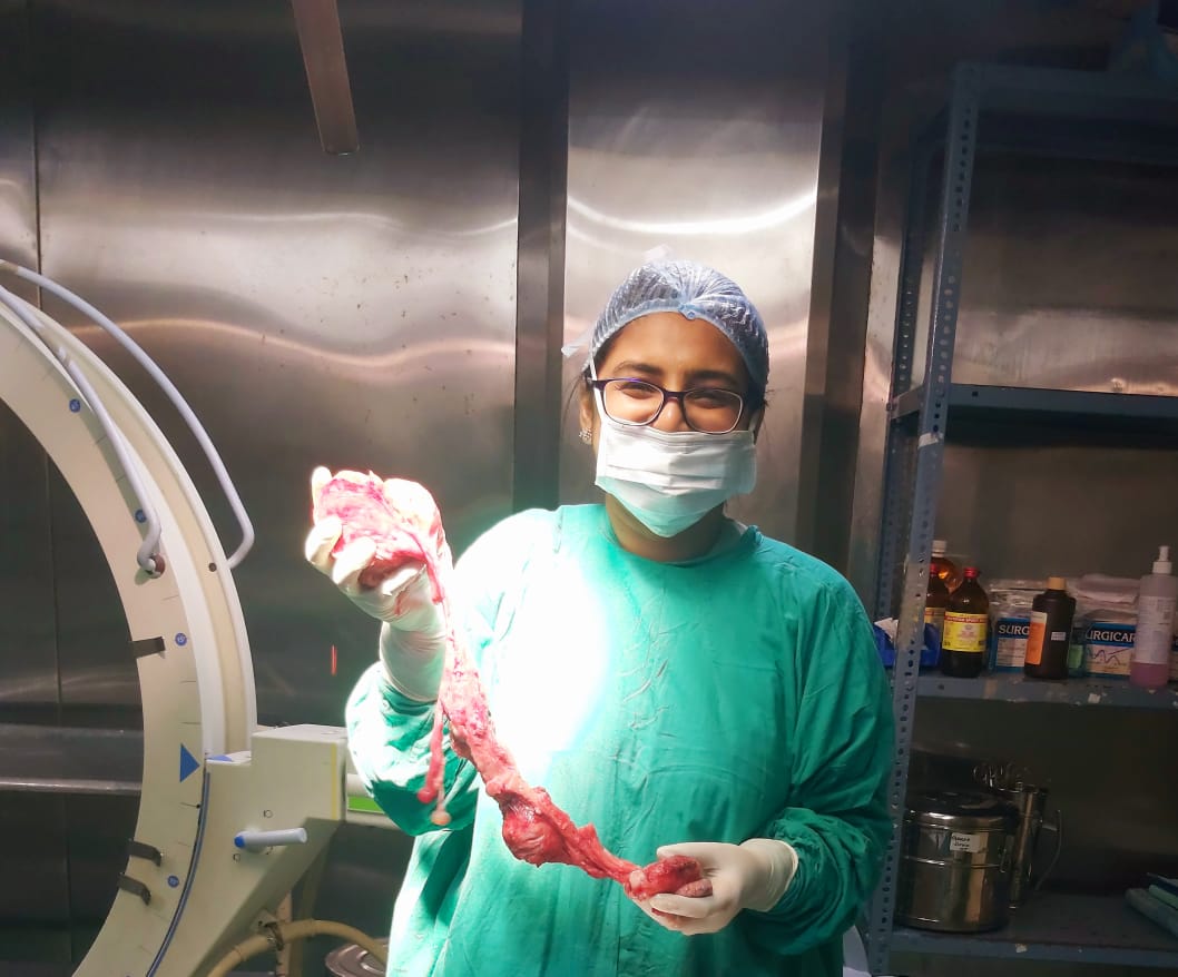 Endometriosis & Ovarian Cyst